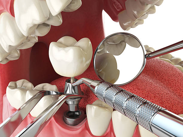 Best Emergency Root Canal Treatment in Antlers, OK